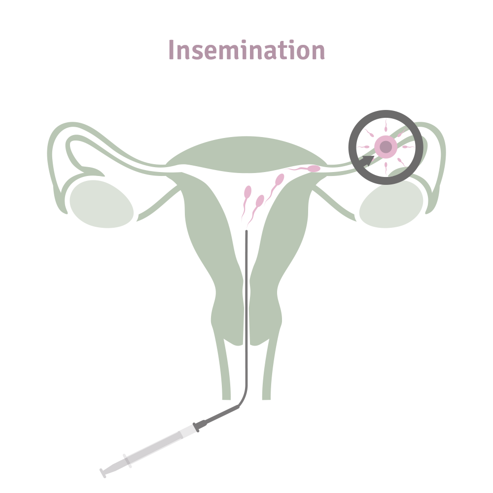 IUI Insemination Grafik